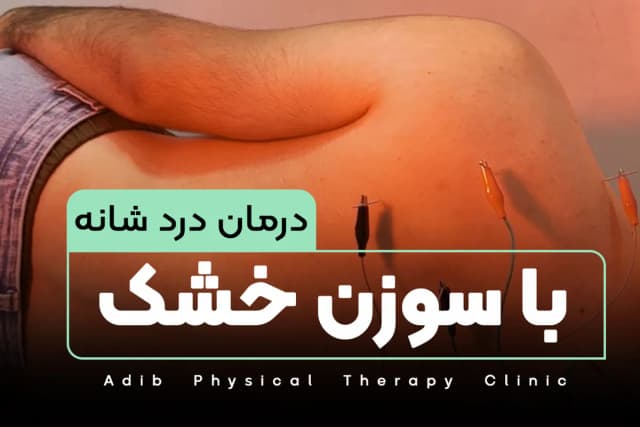 درمان درد شانه با سوزن خشک